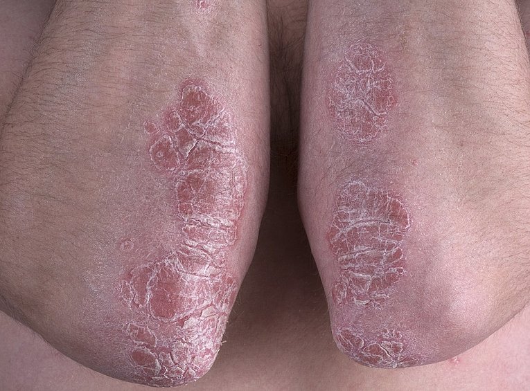 Psoriasis (Schuppenflechte) am Ellenbogen